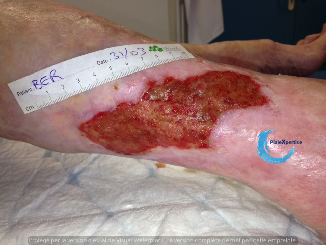 Fichier:Tissu de granulation inflammatoire 70.jpg