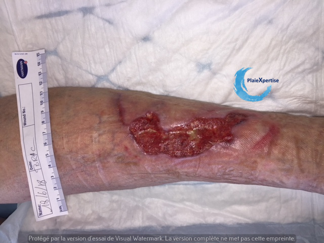 Fichier:Tissu de granulation inflammatoire 72.jpg