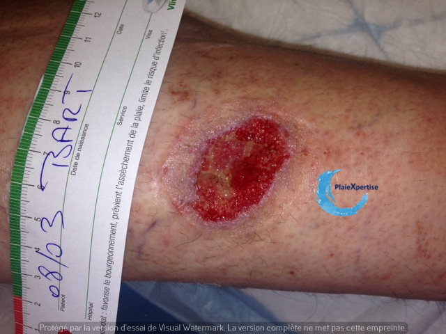 Fichier:Tissu de granulation inflammatoire 69.jpg