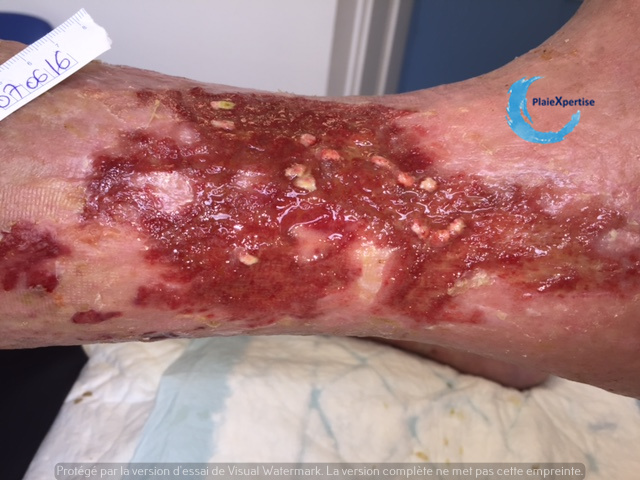 Fichier:Tissu de granulation inflammatoire 67.jpg