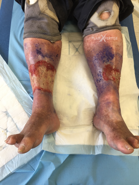 Fichier:Grosses jambes suintantes20.png