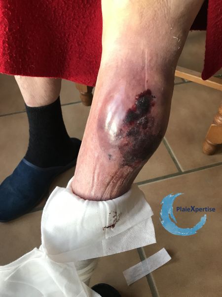 Fichier:Hématome dissequant fermé avec nécrose29.jpg