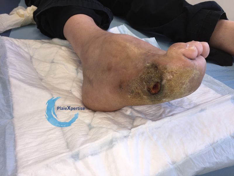Fichier:Pied de Charcot25.jpg