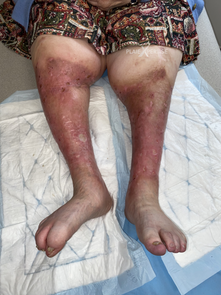 Fichier:Hypodermite chronique36.png