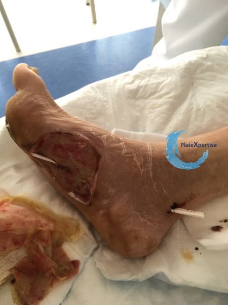 Fichier:Plaies transfixiantes8.jpg