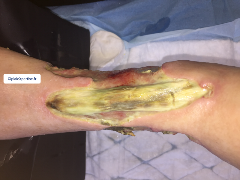 Fichier:Tendon nécrotique humide13.png
