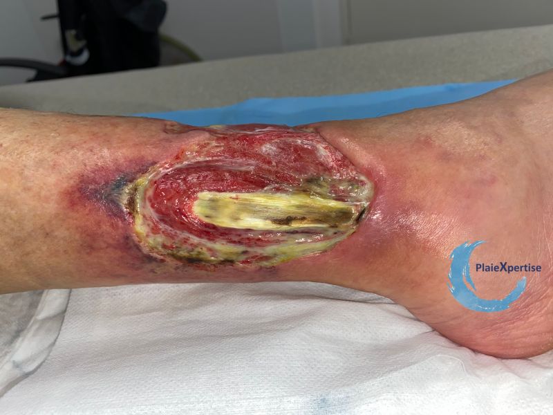 Fichier:Tendon nécrotique humide50.jpg