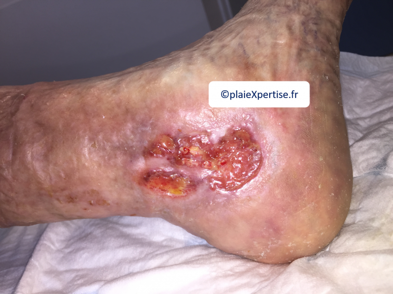 Fichier:Tissu de granulation normal7.png