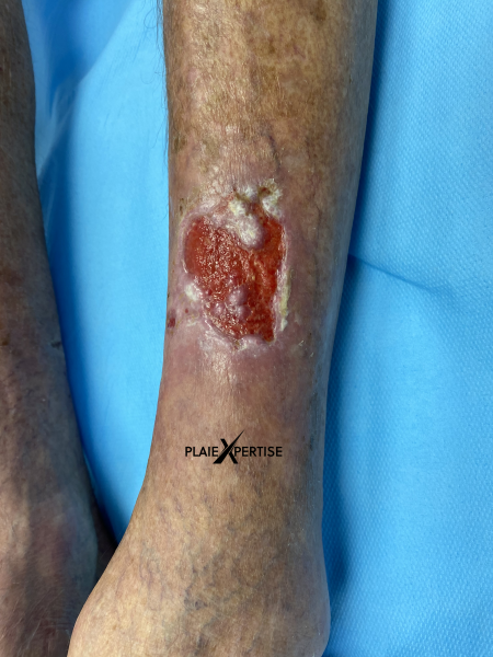 Fichier:Tissu de granulation normal21.png