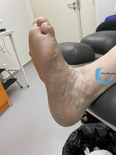 Fichier:Pied de Charcot8.png