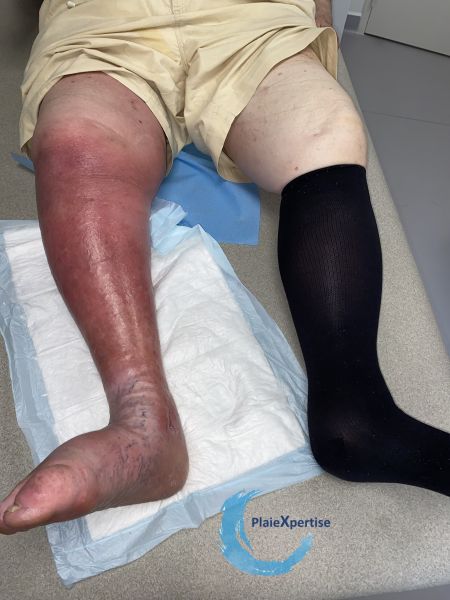 Fichier:Hypodermite chronique64.jpg