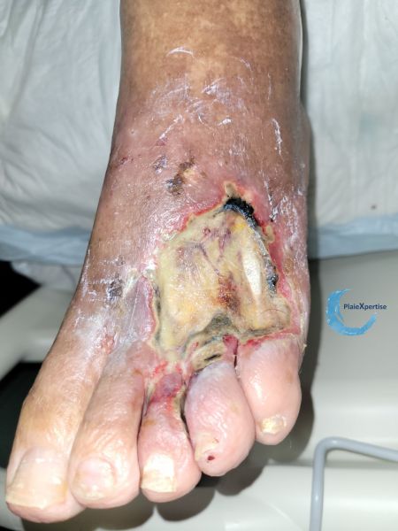 Fichier:Tendon nécrotique humide80.jpg