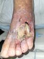 Tendon nécrotique humide80.jpg