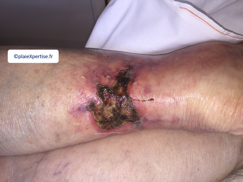 Fichier:Tendon nécrotique sec9.png