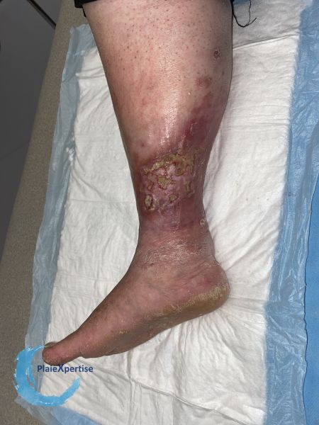 Fichier:Pyoderma gangrenosum63.jpg