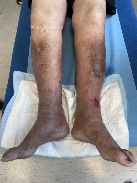 Fichier:Dermiteocre46.png