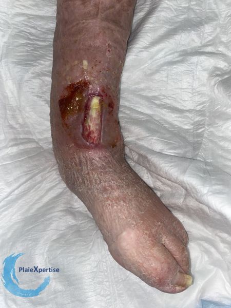 Fichier:Tendon normal41.jpg