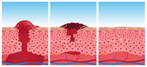 Wound healing.jpg