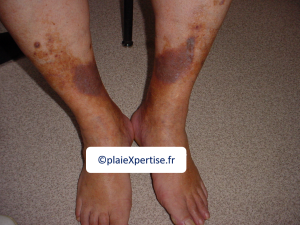 Dermiteocre2.png