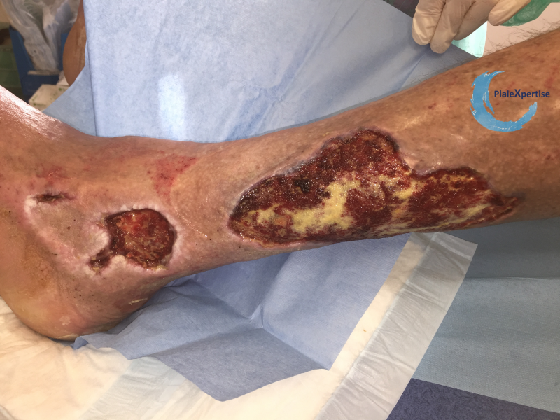 Fichier:Tissu de granulation inflammatoire31.png