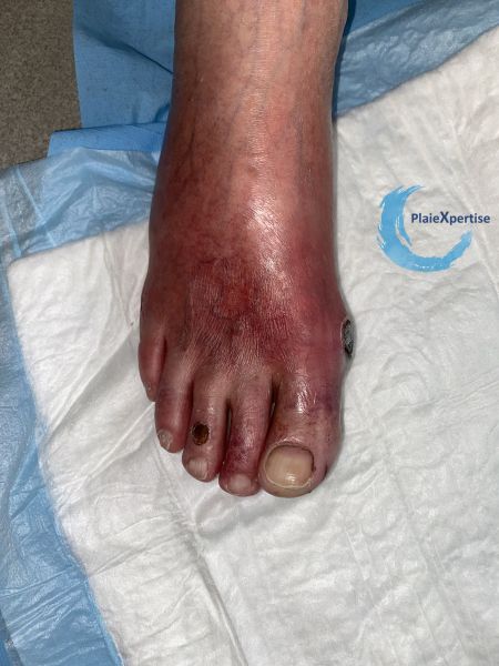 Fichier:Erythrocyanose8.jpg