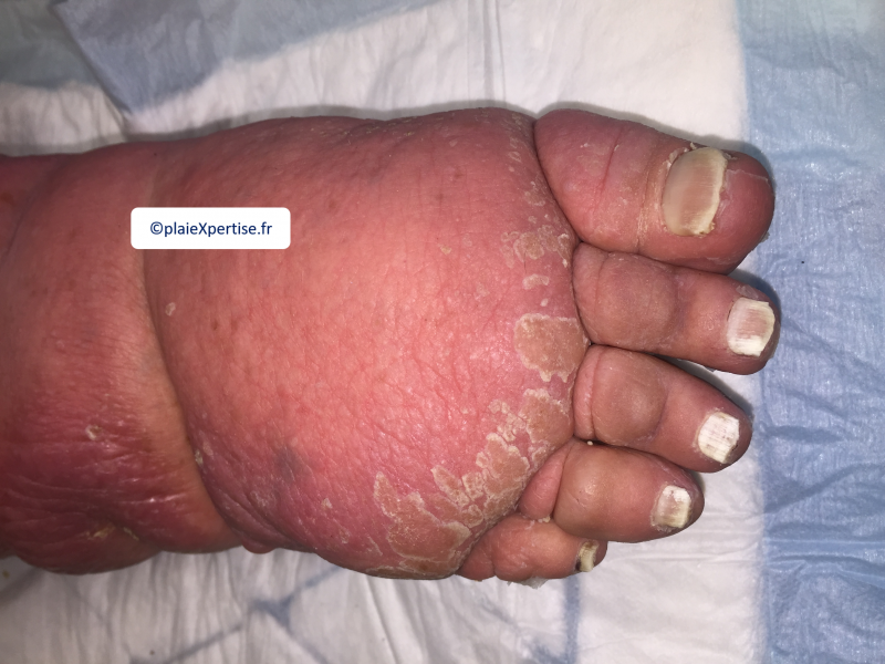 Fichier:Lymphoedème pied14.png