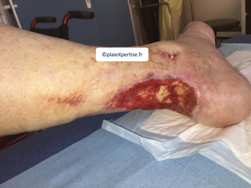 Fichier:Tendon-Reliquat4.png