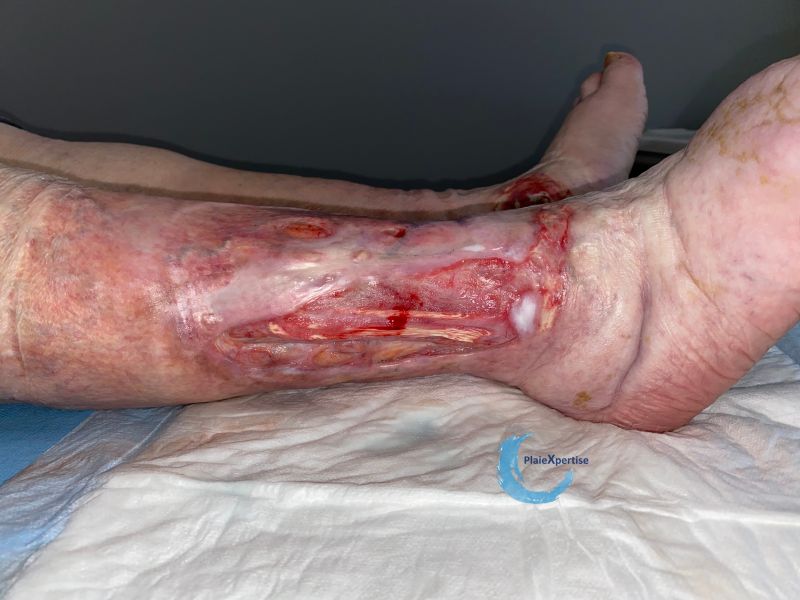 Fichier:Tendon normal50.jpg