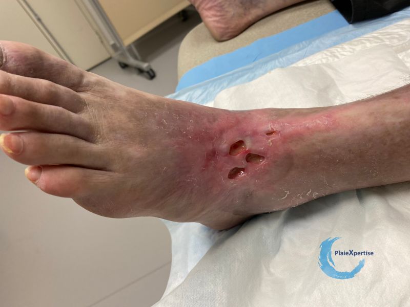 Fichier:Cou de pied76.jpg