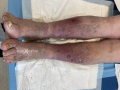 Dermiteocre41.png