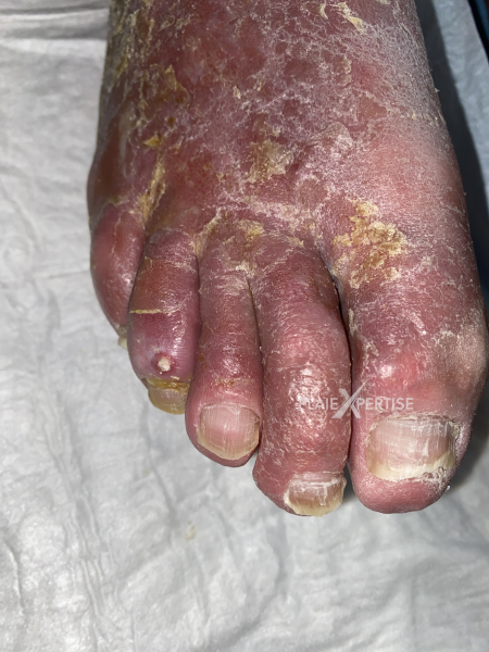 Fichier:Eczéma63.png