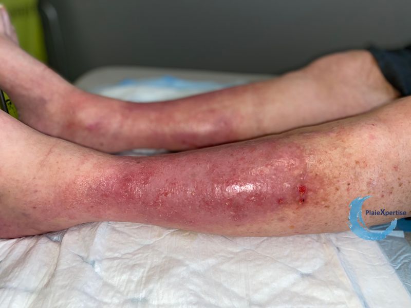 Fichier:Eczéma93.jpg