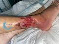 Tendon-Reliquat20.jpg