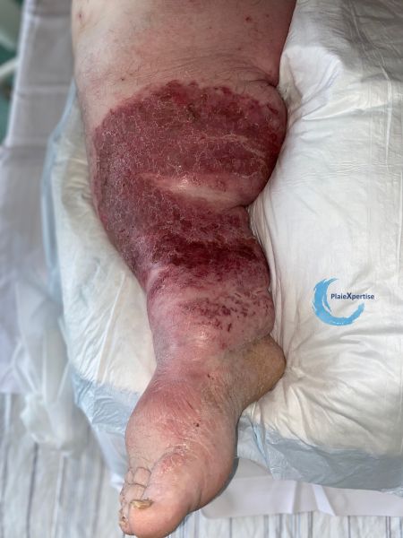 Fichier:Eczéma148.jpg
