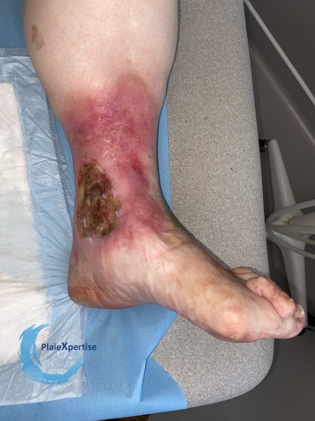 Fichier:Hypodermite chronique60.jpg