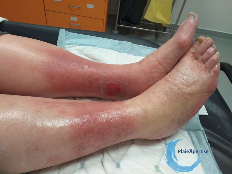 Fichier:Hypodermite chronique65.jpg