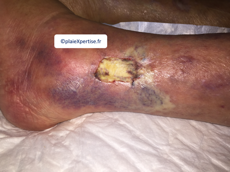 Fichier:Tendon normal14.png