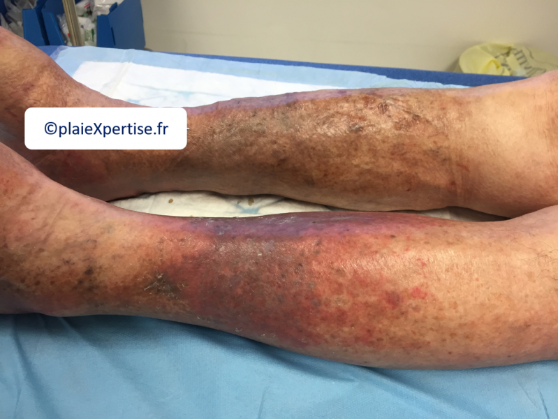 Fichier:Dermiteocre1.png