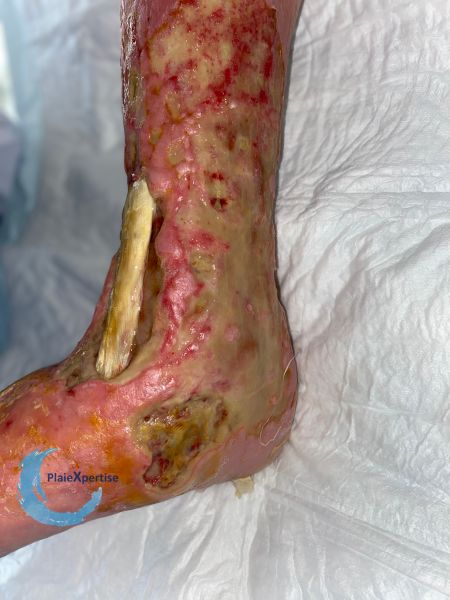 Fichier:Tendon nécrotique humide70.jpg
