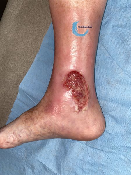 Fichier:Tissu de granulation inflammatoire61.jpg