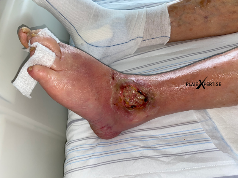 Fichier:Cou de pied45.png