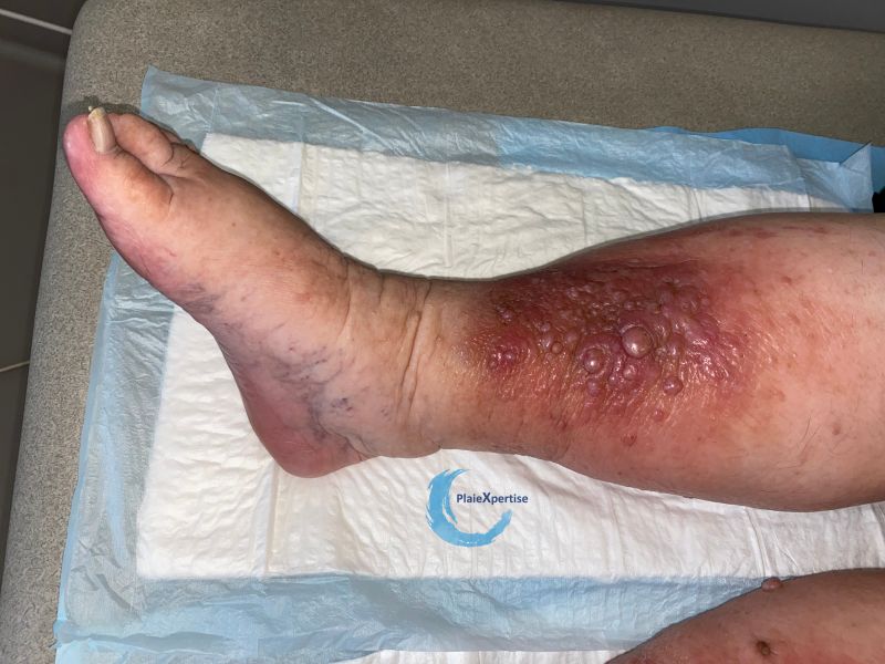 Fichier:Hypodermite chronique74.jpg