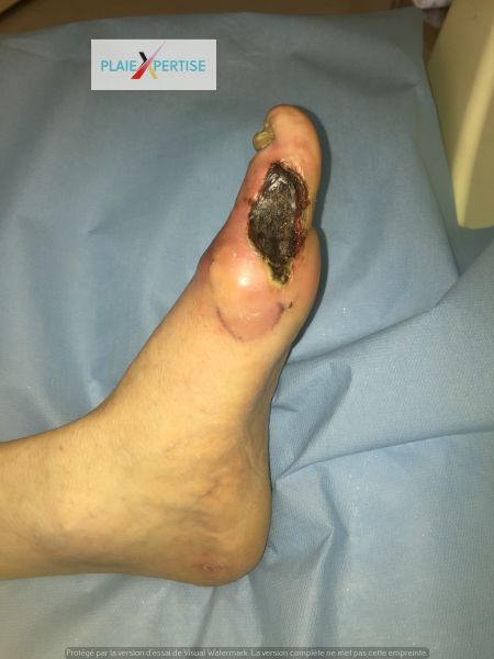 Fichier:Nécrose sèche Pied 7.jpg
