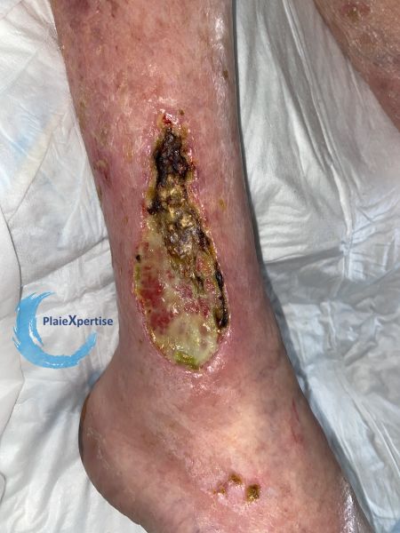 Fichier:Calcifications39.jpg
