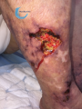 Calciphylaxie6.png