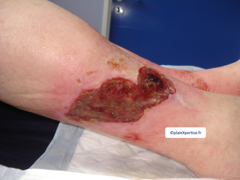 Fichier:Tissu de granulation inflammatoire1.png