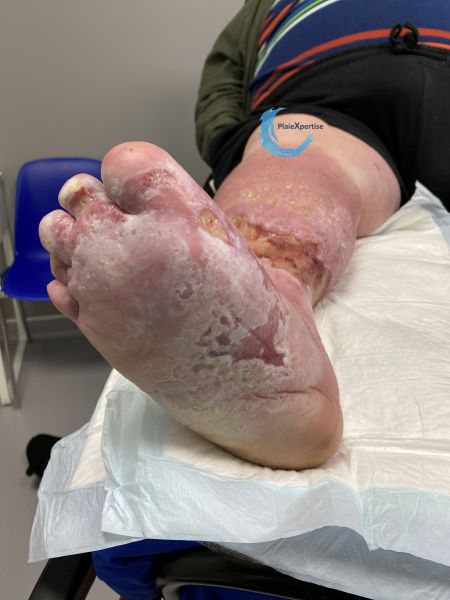 Fichier:Grosses jambes suintantes41.jpg