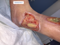 Tendon normal13.png