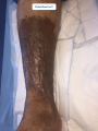 Dermiteocre23.png