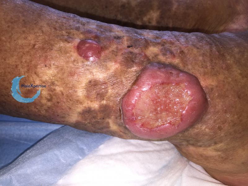 Fichier:Lymphome cutané ulcéré10.png